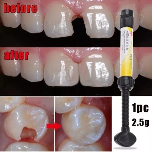 Teeth resin tooth repair - teeth,