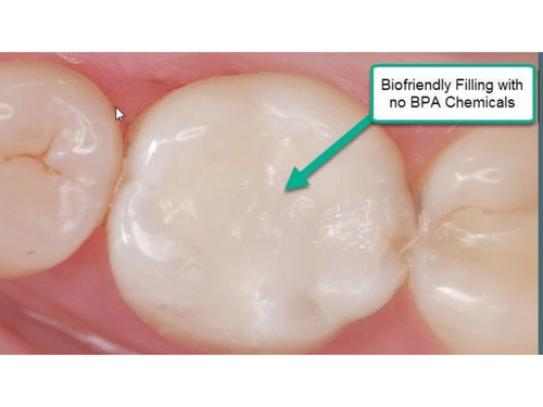 Chipped tooth filling kit diy - chipped,
